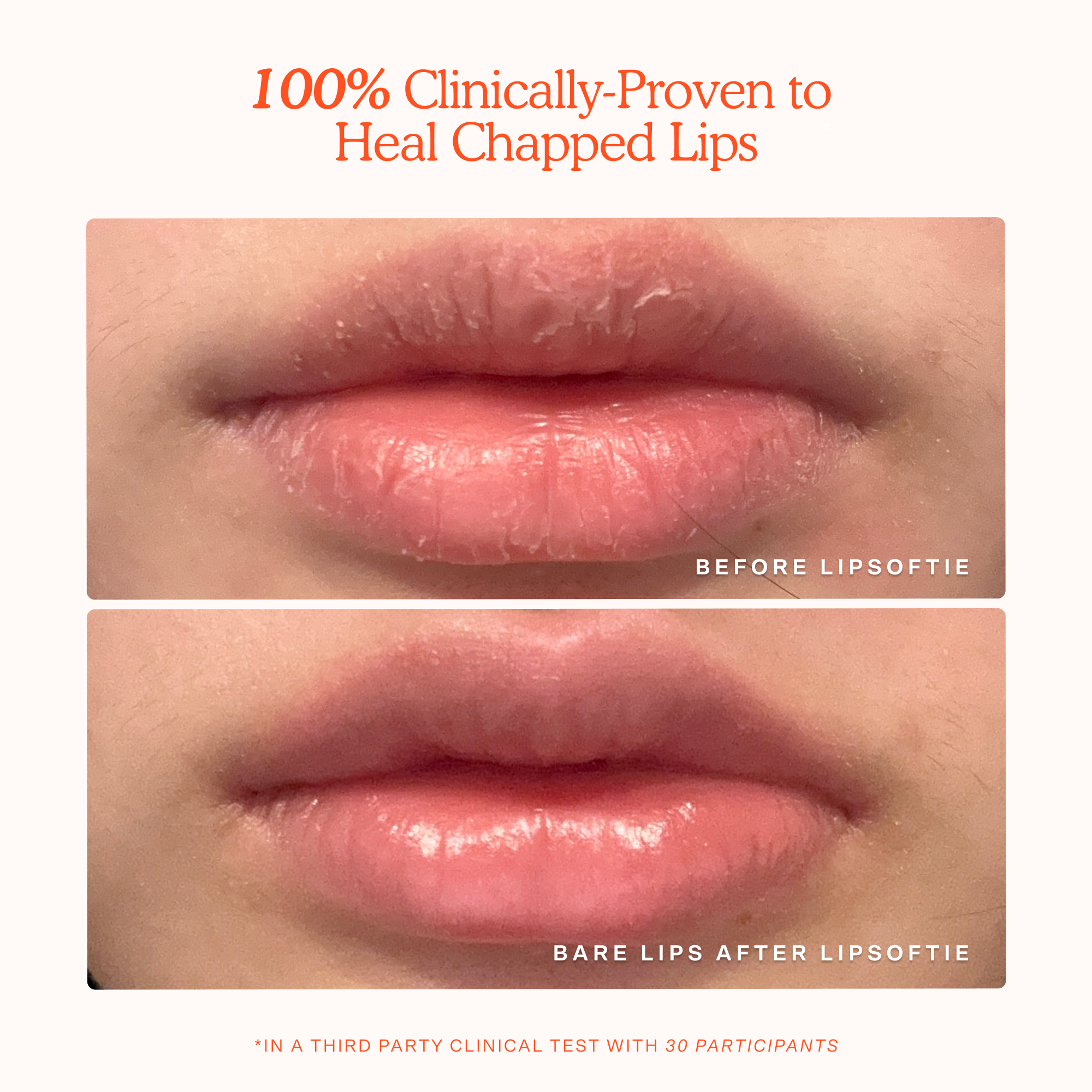 LipSoftie® Lip Treatment - Image 4